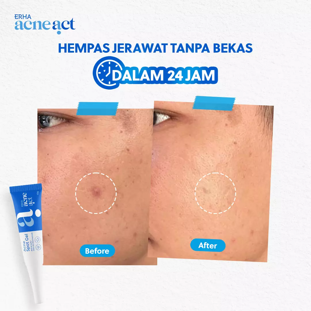 ERHA Acneact Acne Spot Gel 10g - Gel Totol Jerawat |  Acne Treatment | Salicylic Acid Niacinamide