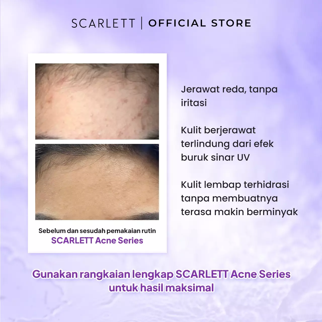 Scarlett Whitening Acne Day Cream