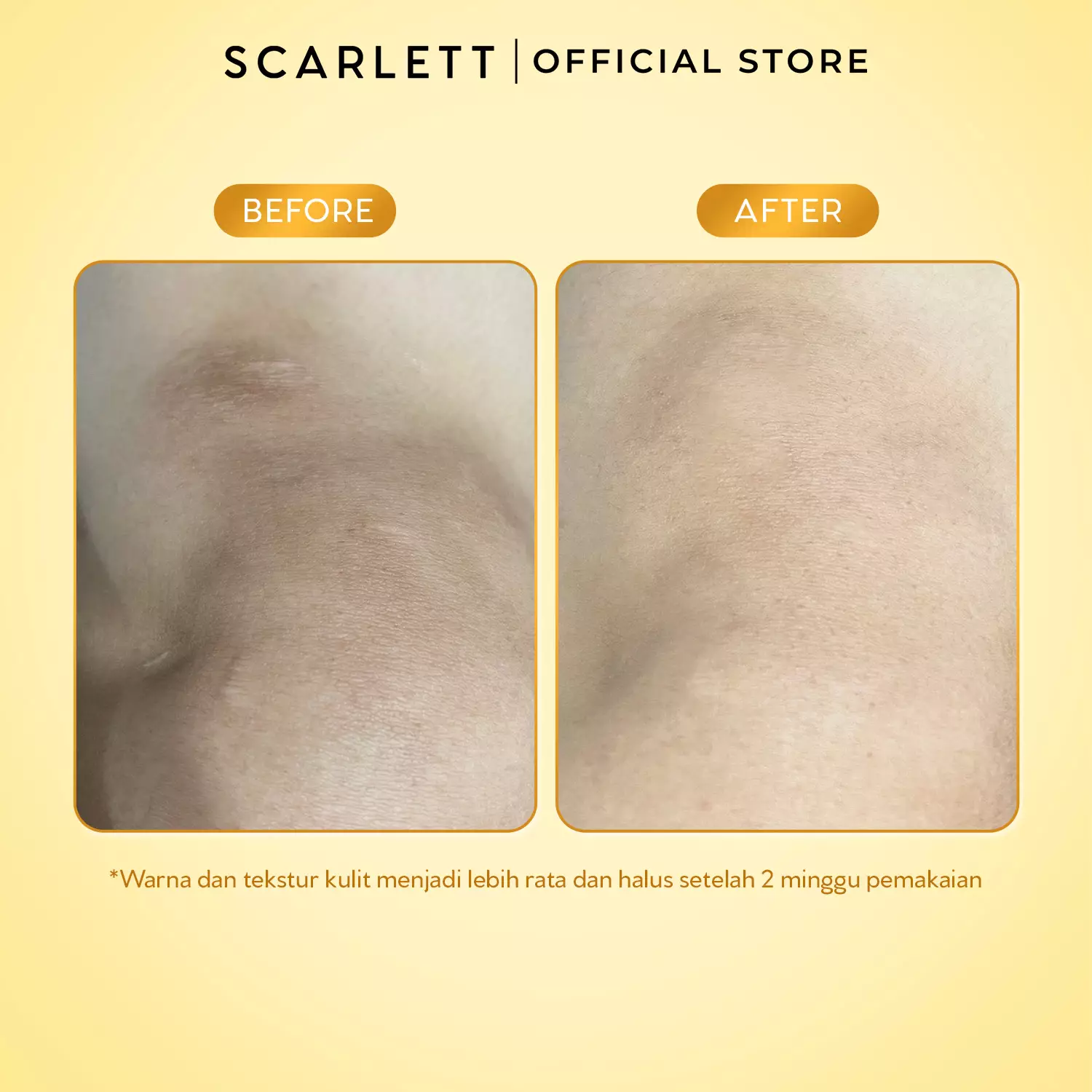 [NEW LAUNCH] SCARLETT Intense Brightening AHA Body Booster 10% AHA BHA PHA PRO-WHITE