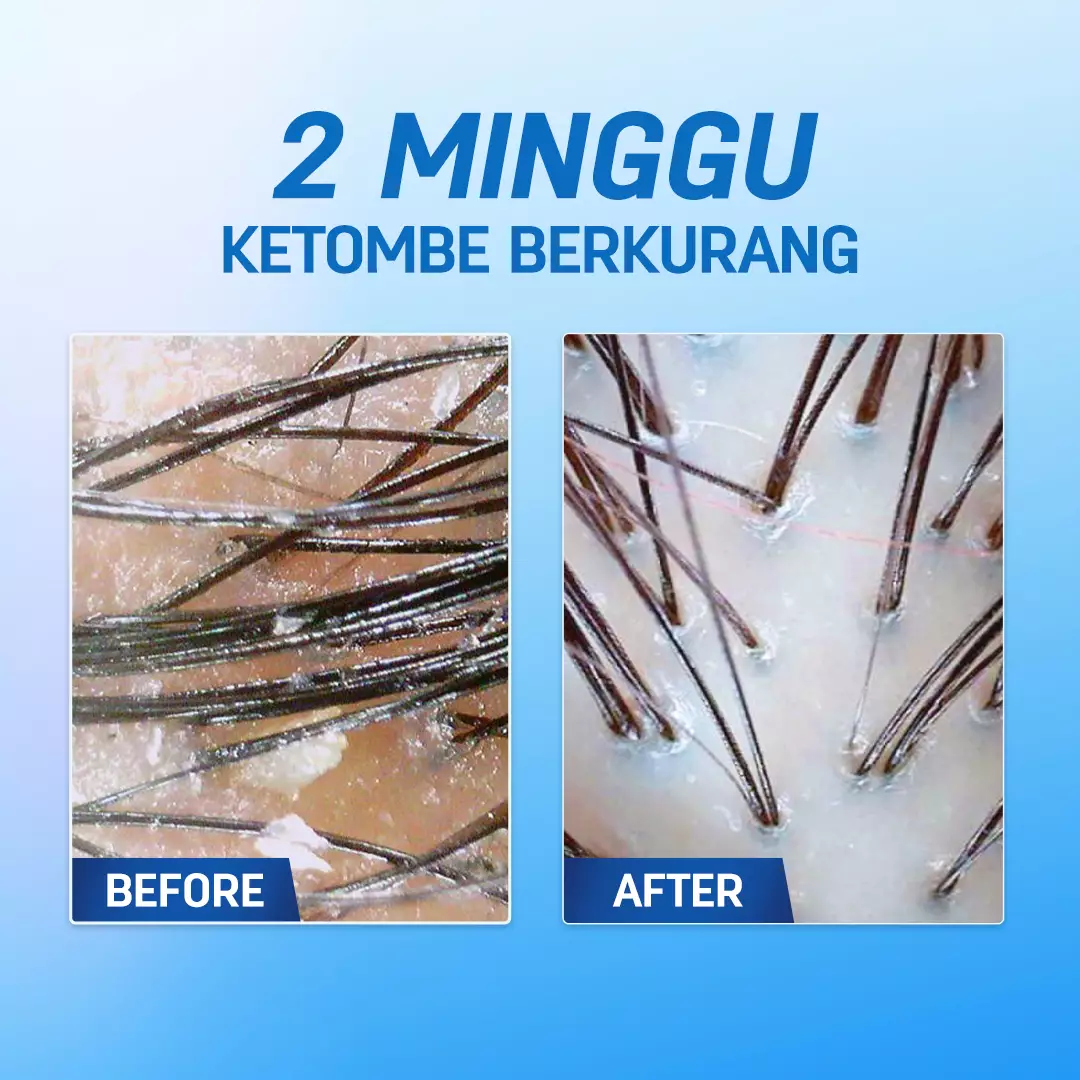 [ANTI KETOMBE] ERHAIR Scalperfect Anti Dandruff Shampoo 100ml 250ml 370ml - Sampo Anti Ketombe & Seboroik | Membersihkan Kulit Kepala Dan Rambut | Rekomendasi Ahli Dermatologi