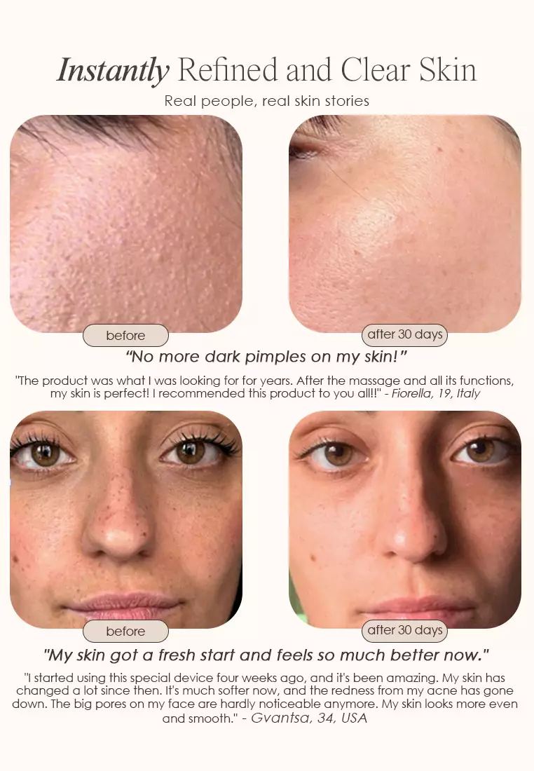 Reinvo | Facial Microdermabrasion Wand