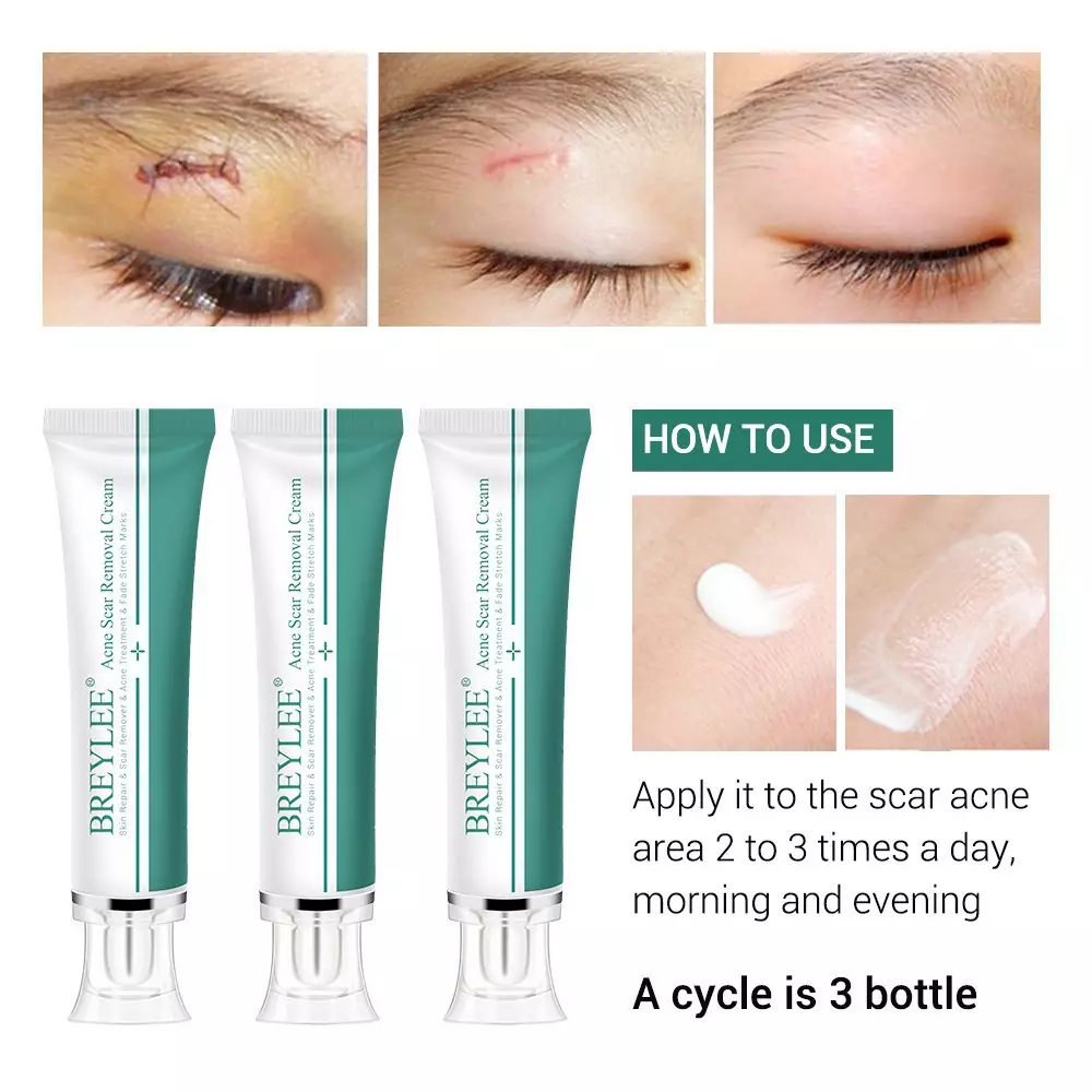 BREYLEE Krim Penghilang Noda Bekas Jerawat, Luka & Stretch Mark (30g)