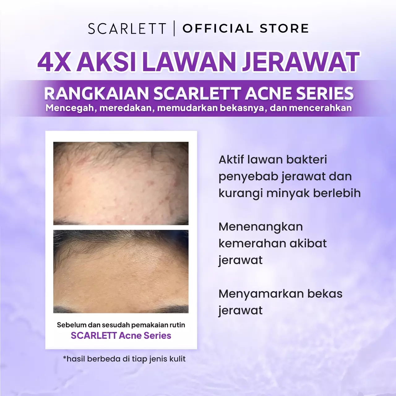 Scarlett Whitening Acne Series