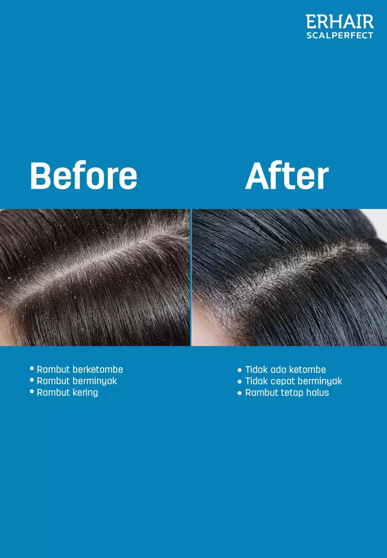 [ANTI KETOMBE] ERHAIR Scalperfect Anti Dandruff Shampoo 100ml  - Sampo Anti Ketombe & Seboroik | Membersihkan Kulit Kepala Dan Rambut | Rekomendasi Ahli Dermatologi