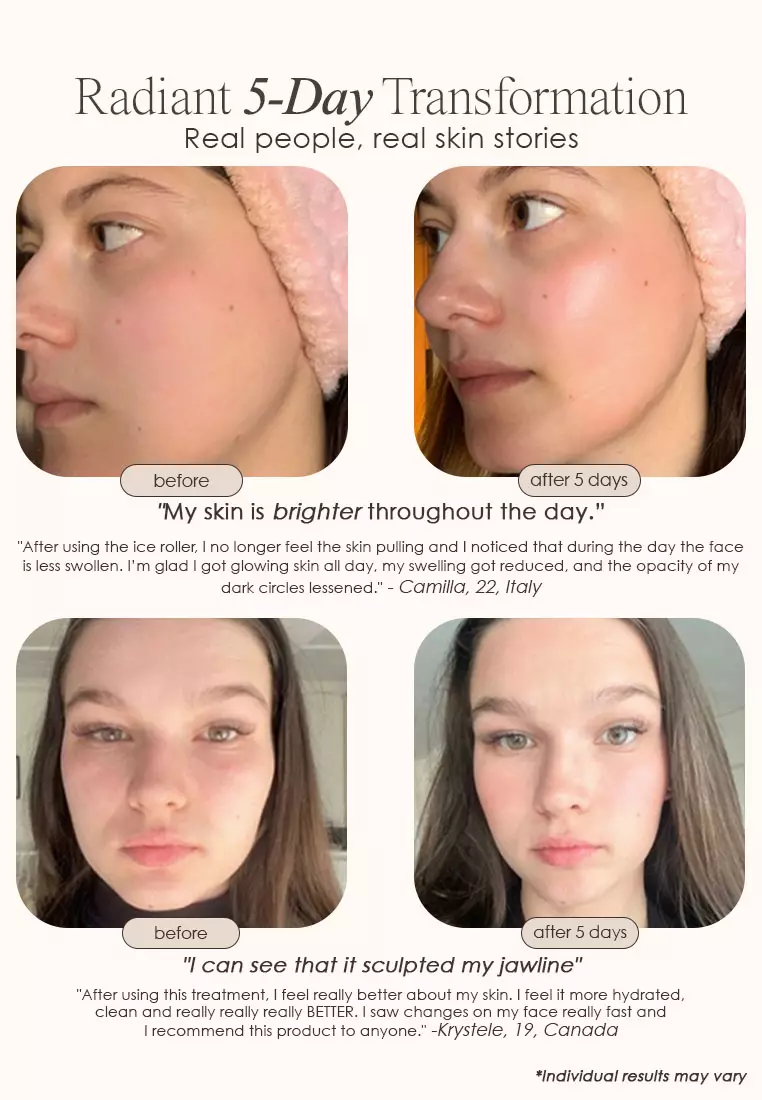 The Ice Roller | Cryotherapy Treatment