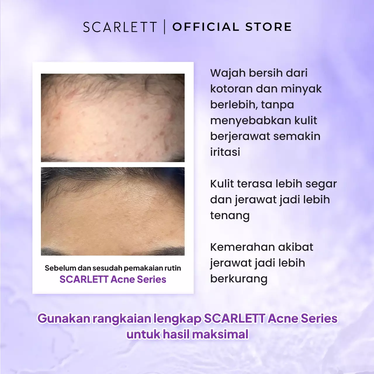 Scarlett Whitening Acne Facial Wash