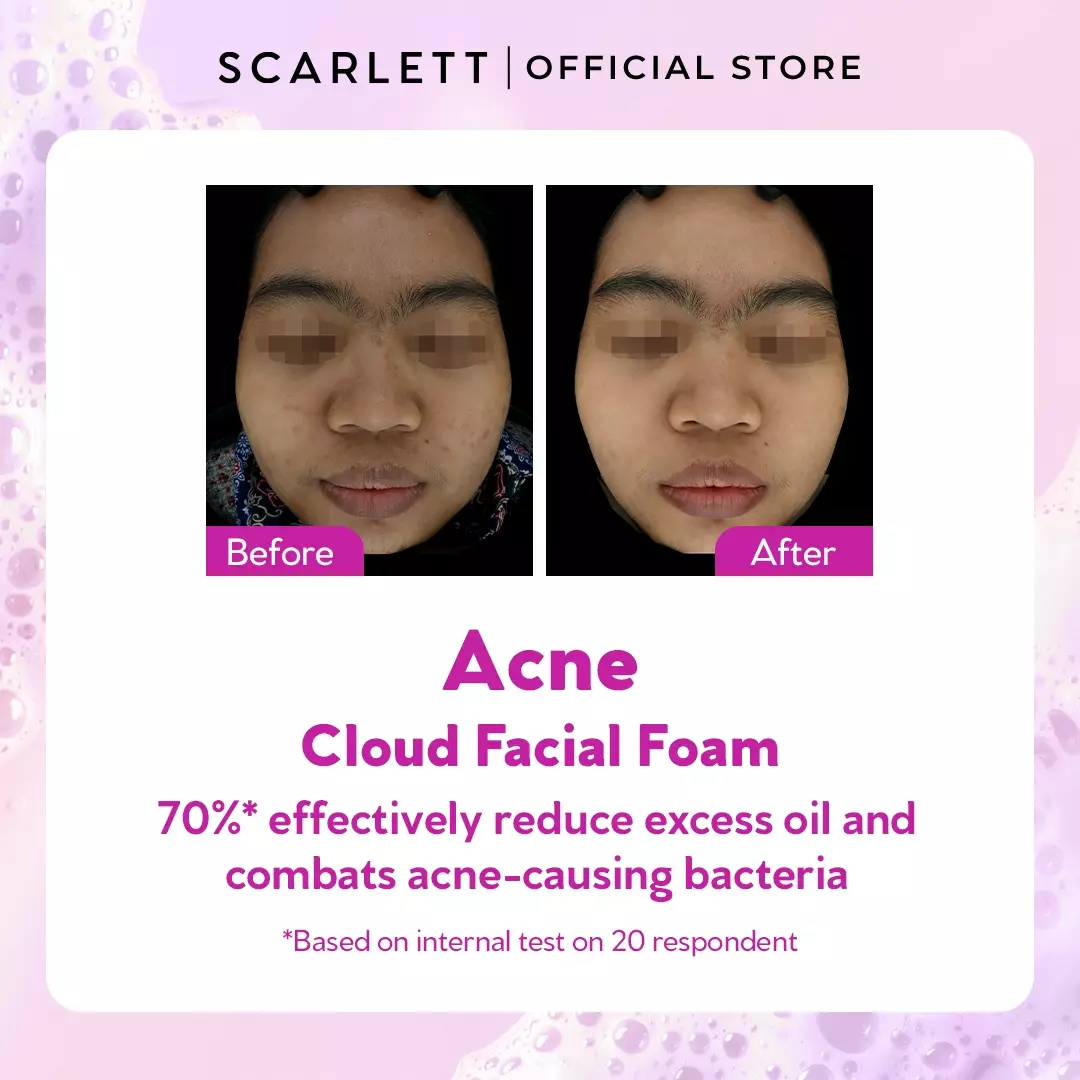 Scarlett Whitening Acne Gentle Skin Cloud Facial Foam
