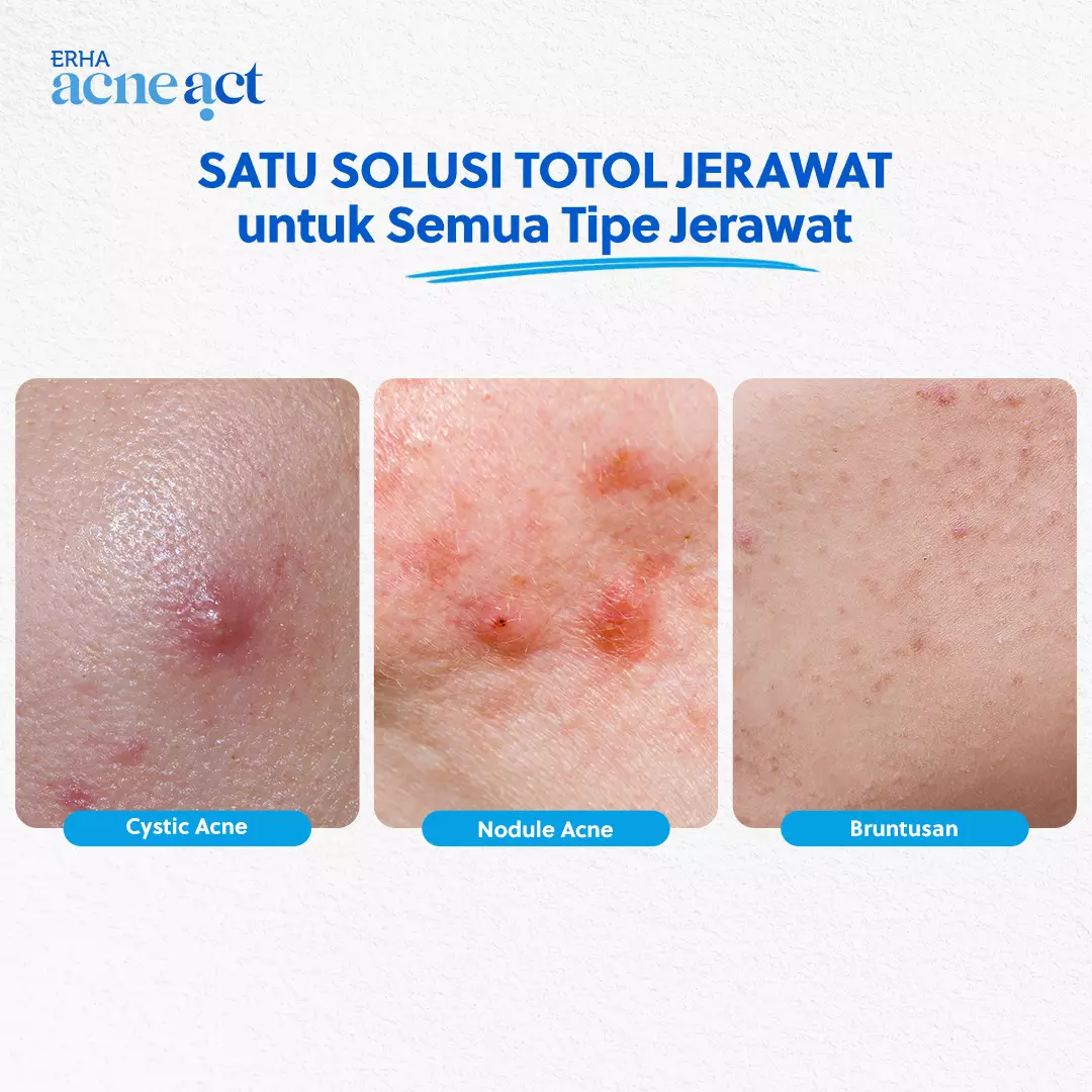 ERHA Acneact Acne Spot Gel 10g - Gel Totol Jerawat |  Acne Treatment | Salicylic Acid Niacinamide