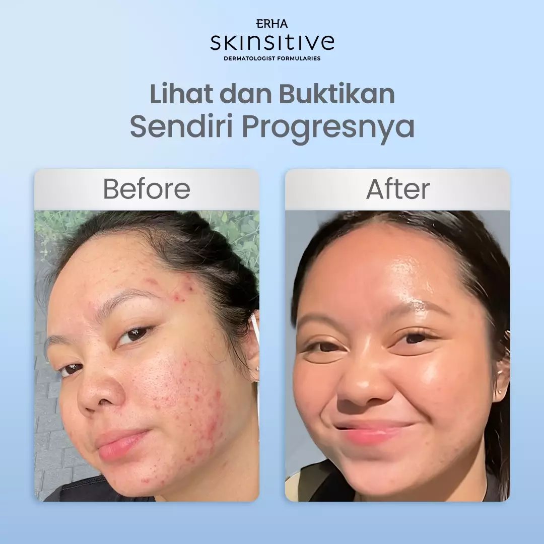 ERHA Skinsitive Ultracalm Face Serum 30g | Serum untuk Memperkuat Skin Barrier | Menenangkan Kulit Sensitif, Kemerahan, Iritasi, Breakout | Mengandung Calming Agent & Moisturizing | Mengandung Panthenol, Vitamin E