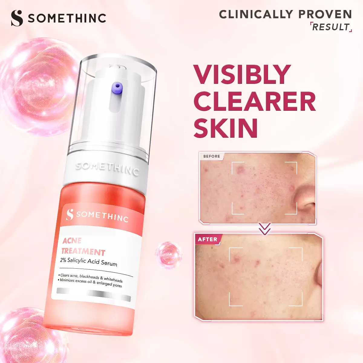 SOMETHINC Acne Treatment 2% Salicylic Acid Serum - 20ml