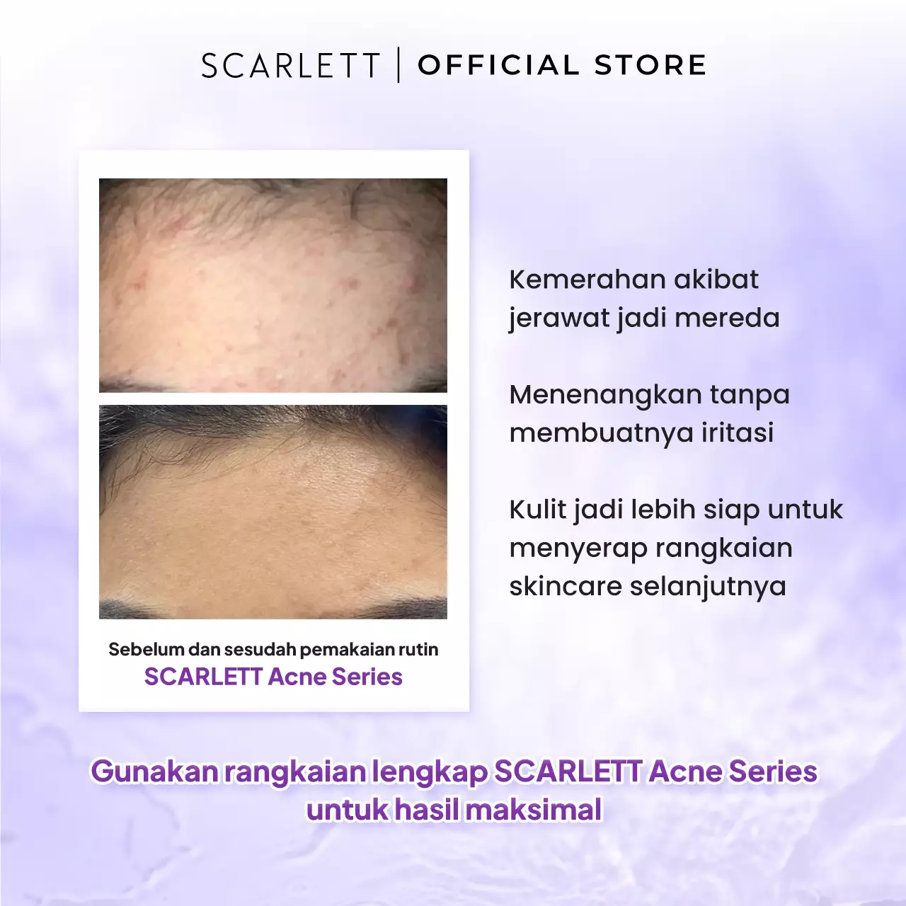 Scarlett Whitening Acne Essence Toner