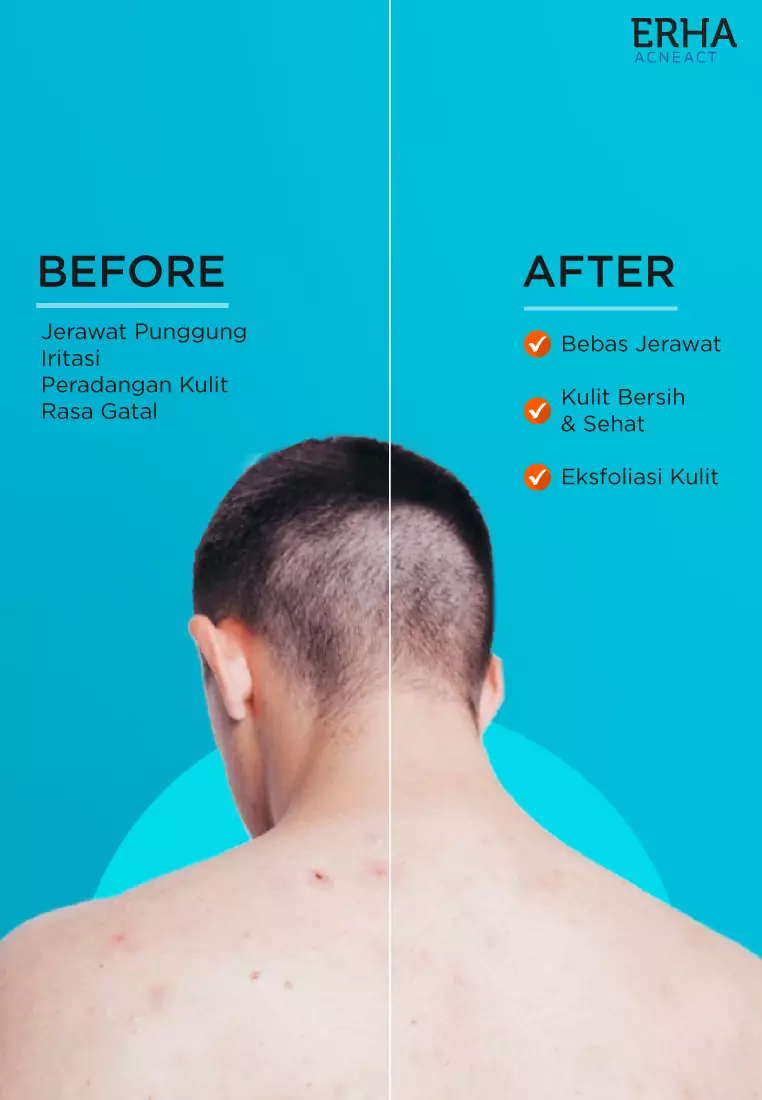 Jual Erha ERHA Acneact Care Lab Acne Back Spray 100 Ml Obat Jerawat