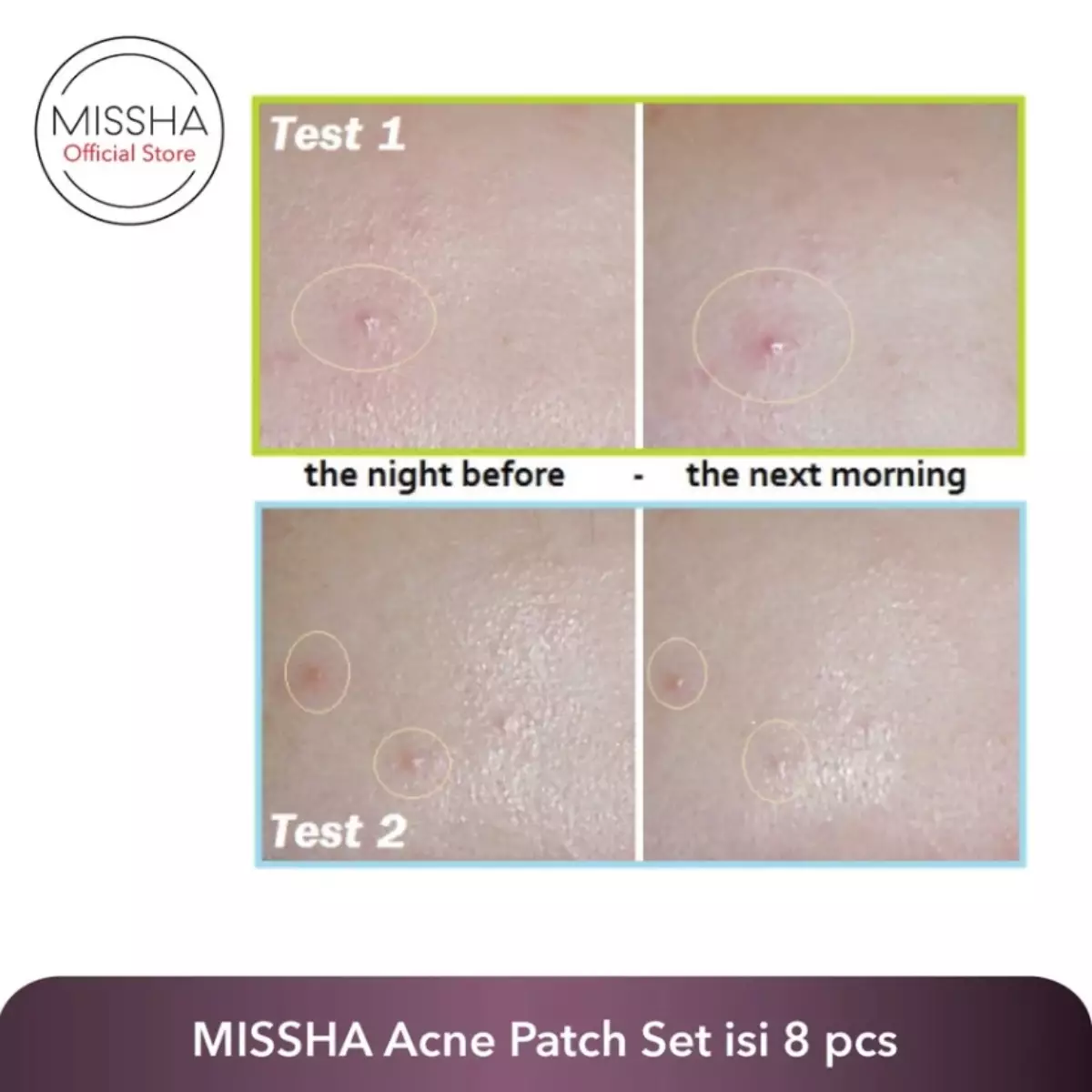 Missha Acne Patch Set (isi 8pcs per box)
